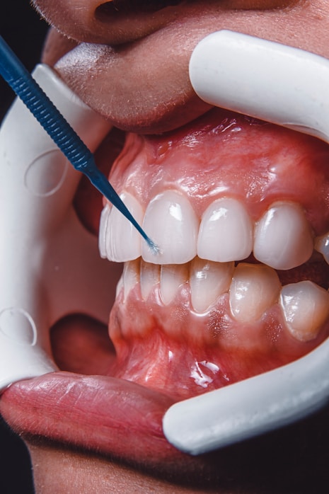 Scaling & Polishing