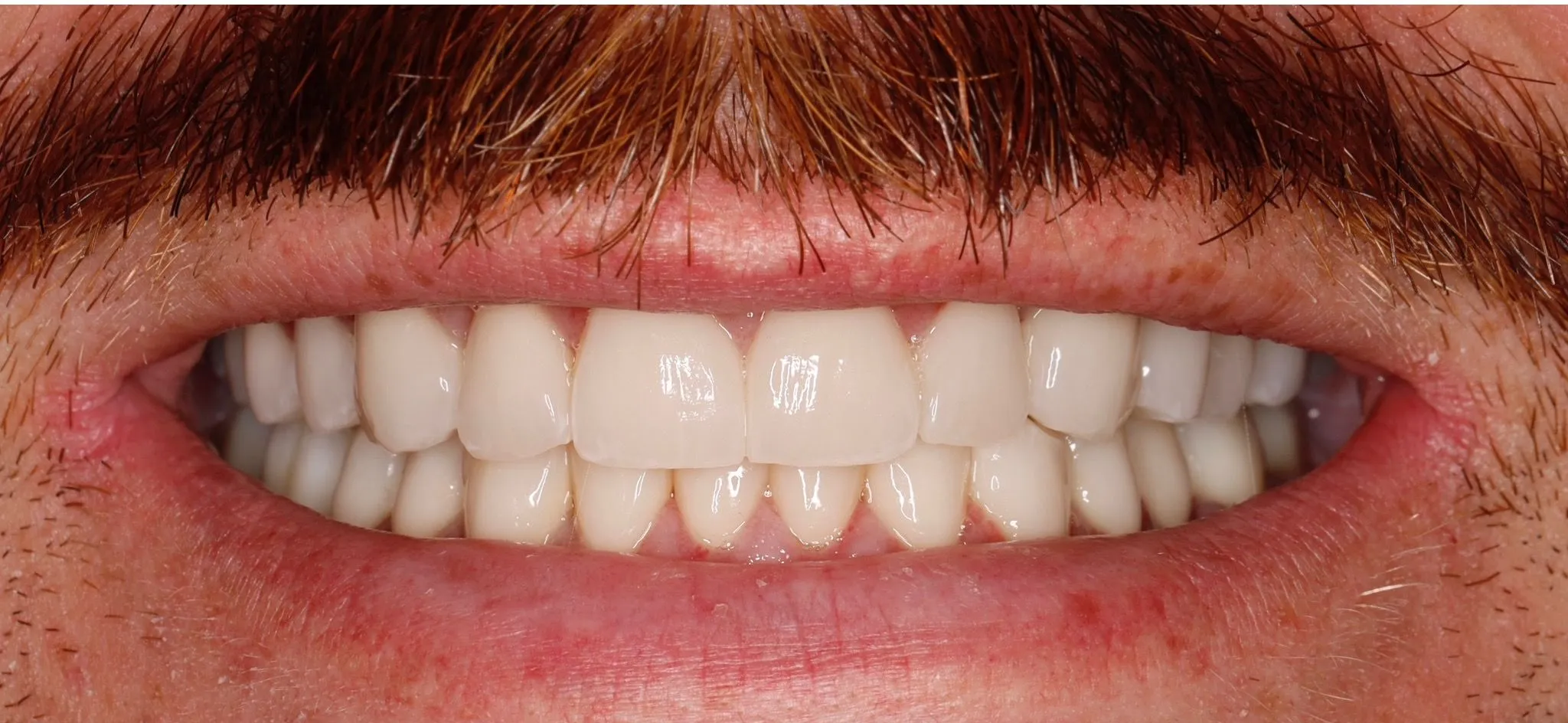 Case 1 After