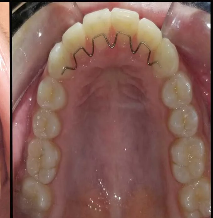 Case 4 After