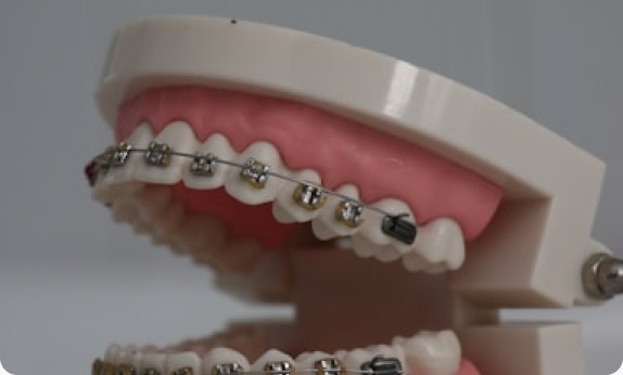 Orthodontic Braces