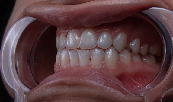 Scaling & Polishing