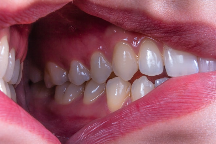 Teeth Bleaching
