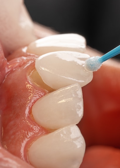 Veneers